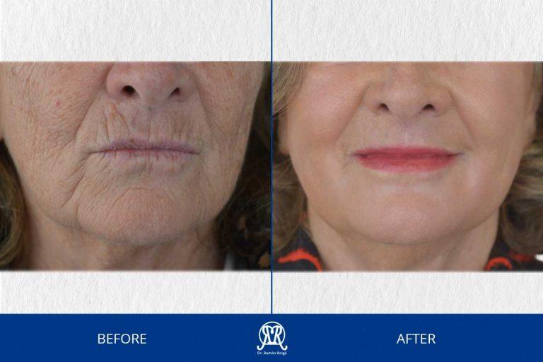 Case 14: Lower Face