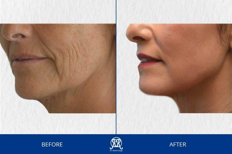 Case 17: Lower Face
