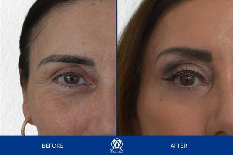 Case 15: Upper Face