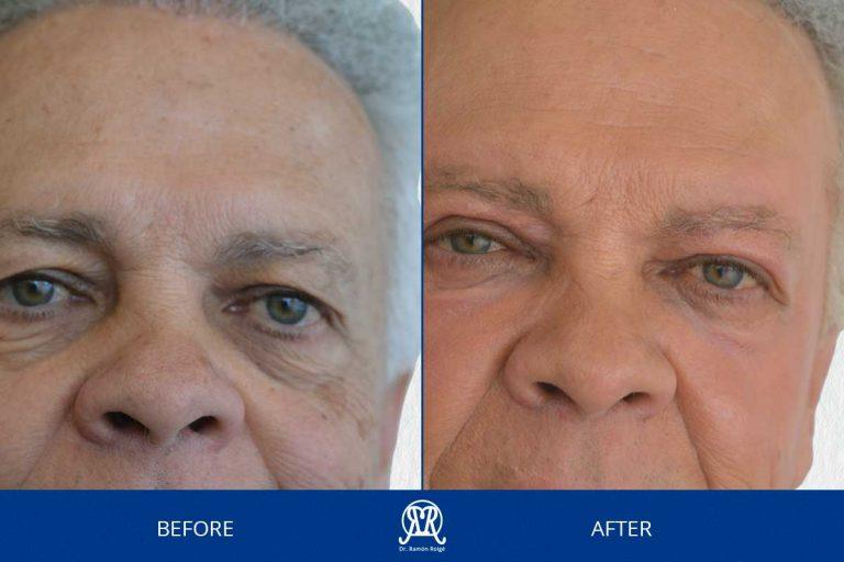 Case 16: Upper Face