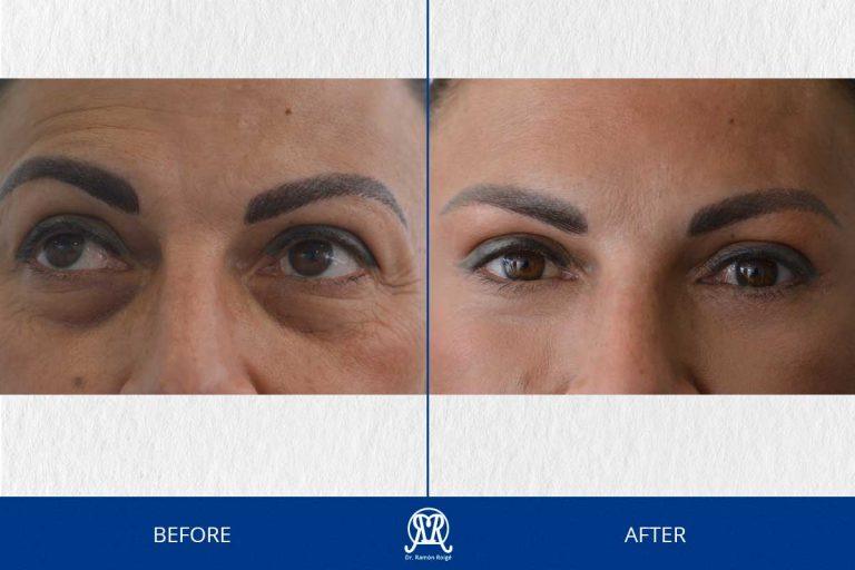 Case 6: Lower Eyelid