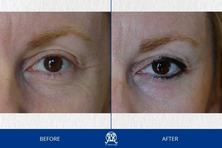 Case 10: Lower Eyelid