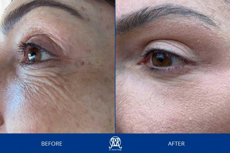 Case 3: Lower Eyelid