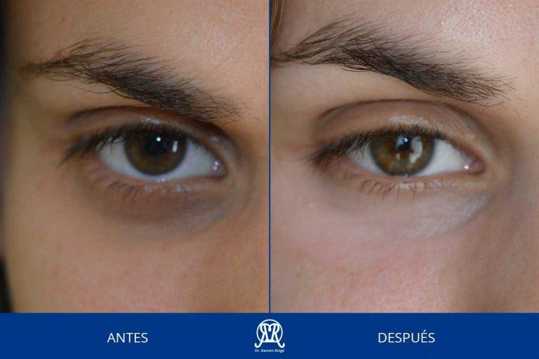 Caso 5: Ojeras oscuras