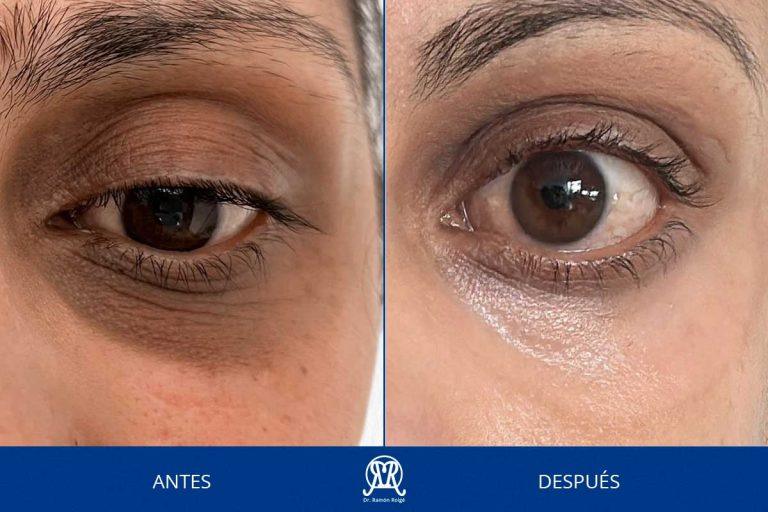 Caso 9: Ojeras pigmentadas