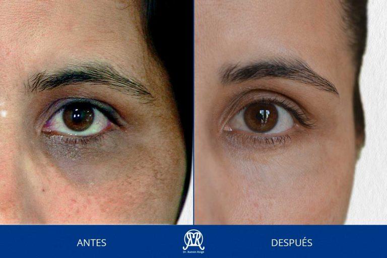 Caso 2: Ojeras pigmentadas