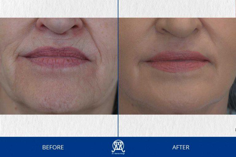 Case 4: Complete Molding Lip