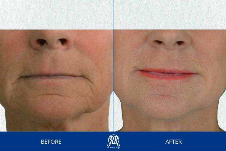 Case 2: Complete Molding Lip