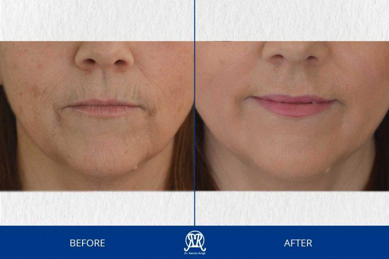 Case 8: Complete Molding Lip