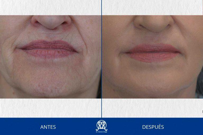 Caso 4: Molding lip completo