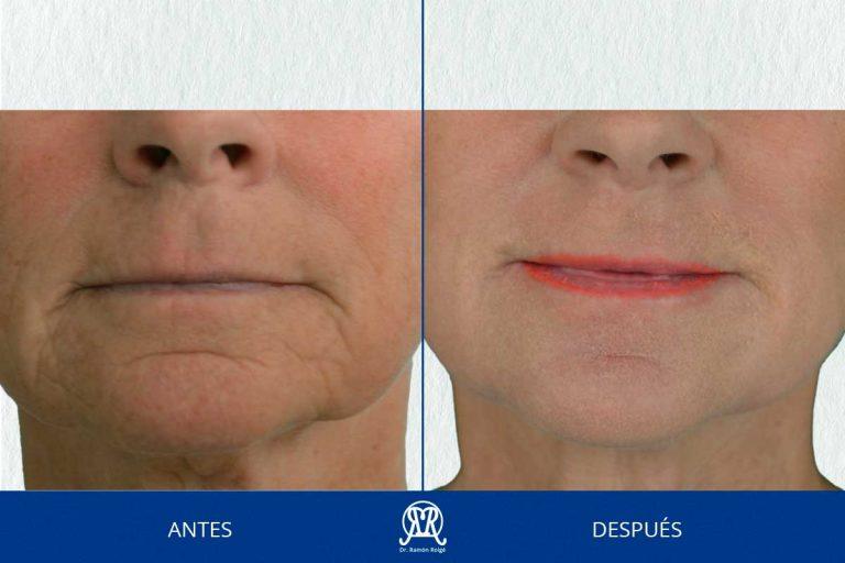Caso 2: Molding lip completo