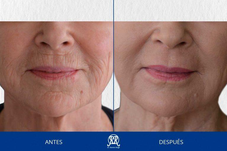 Caso 6: Molding lip completo