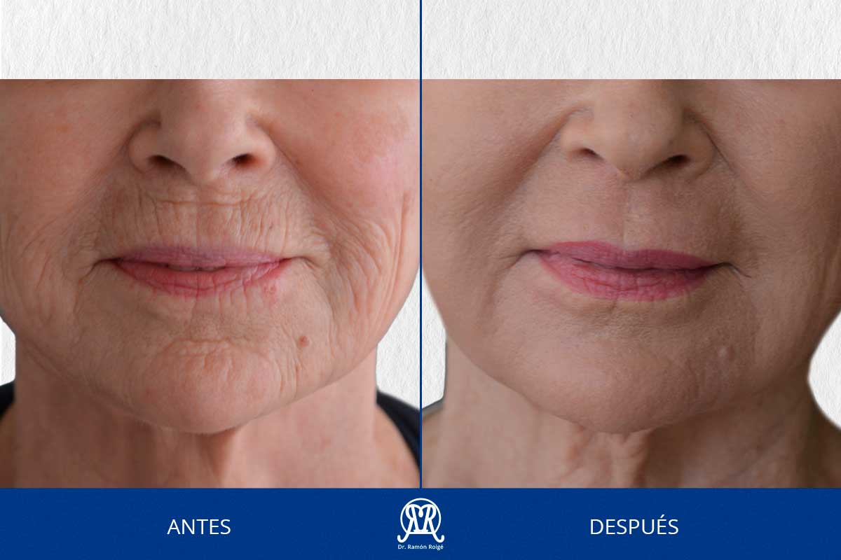 Caso 6: Molding lip completo