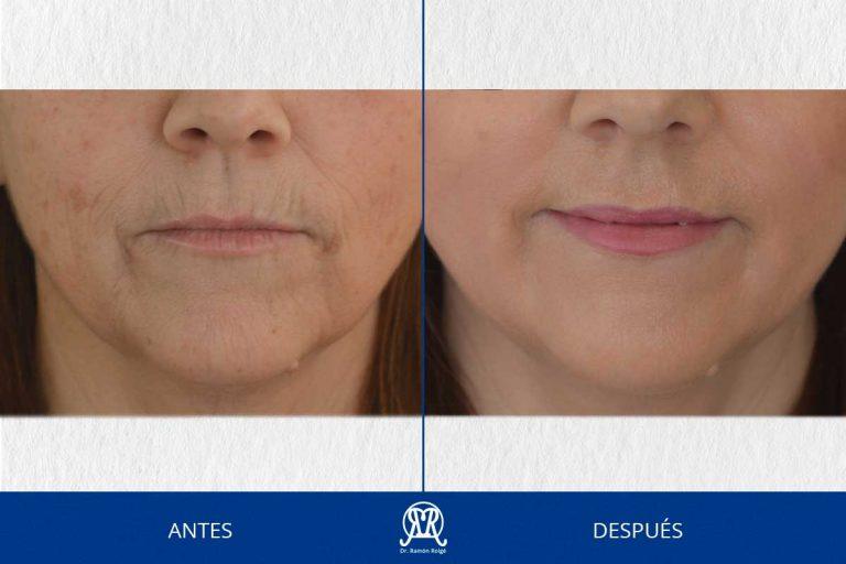 Caso 8: Molding lip completo