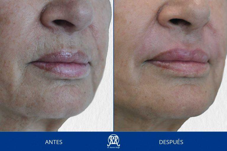Caso 5: Molding lip labio superior