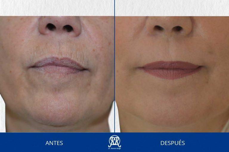 Caso 7: Molding lip labio superior