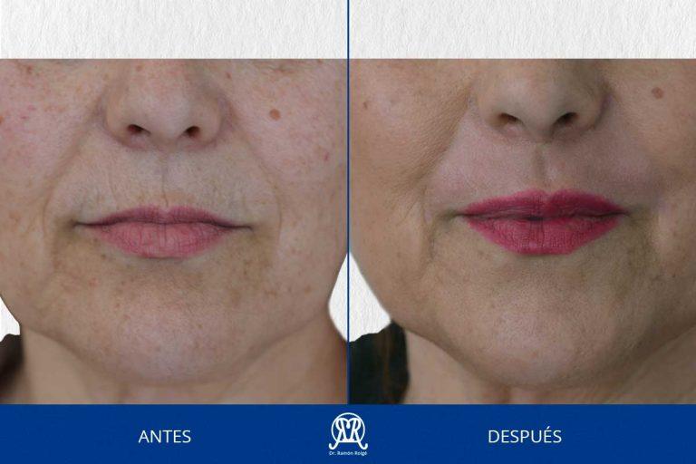 Caso 3: Molding lip labio superior