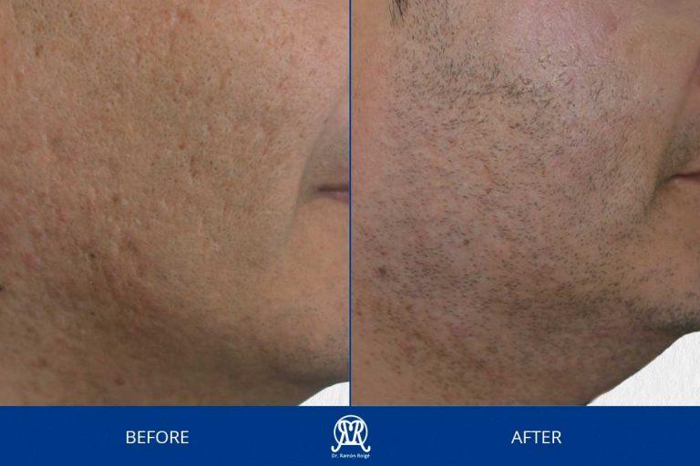 Case 10: Acne Scars