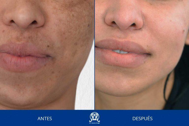 Caso 4: Melasma