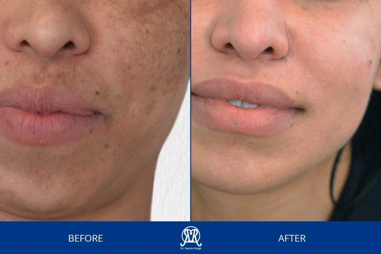 Case 4: Melasma