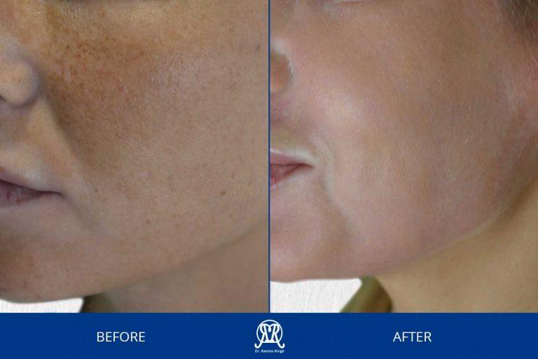 Case 12: Melasma
