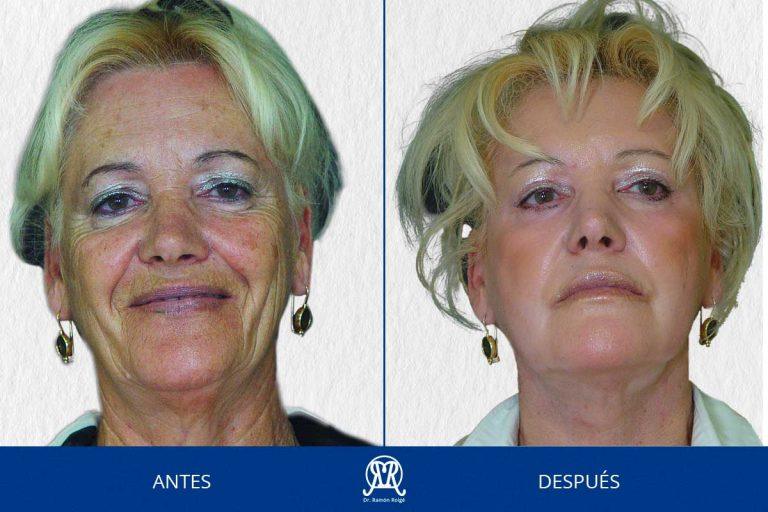 Caso 7: Arrugas