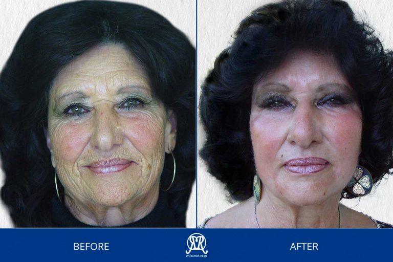 Case 5: Wrinkles