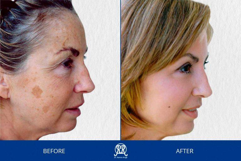 Case 3: Wrinkles & Dark Spots