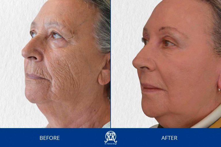 Case 11: Wrinkles