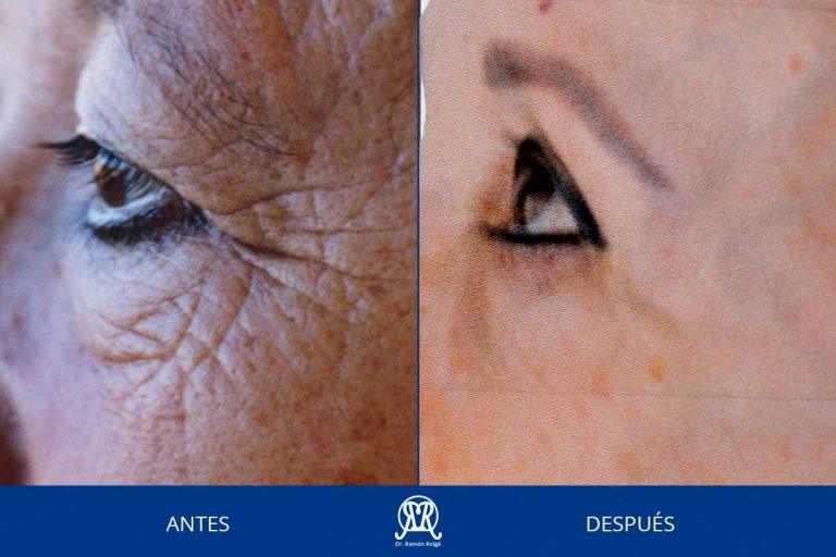Caso 12: Contour Completo