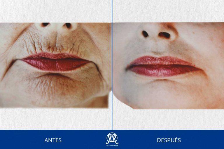 Caso 1: Molding Lip completo