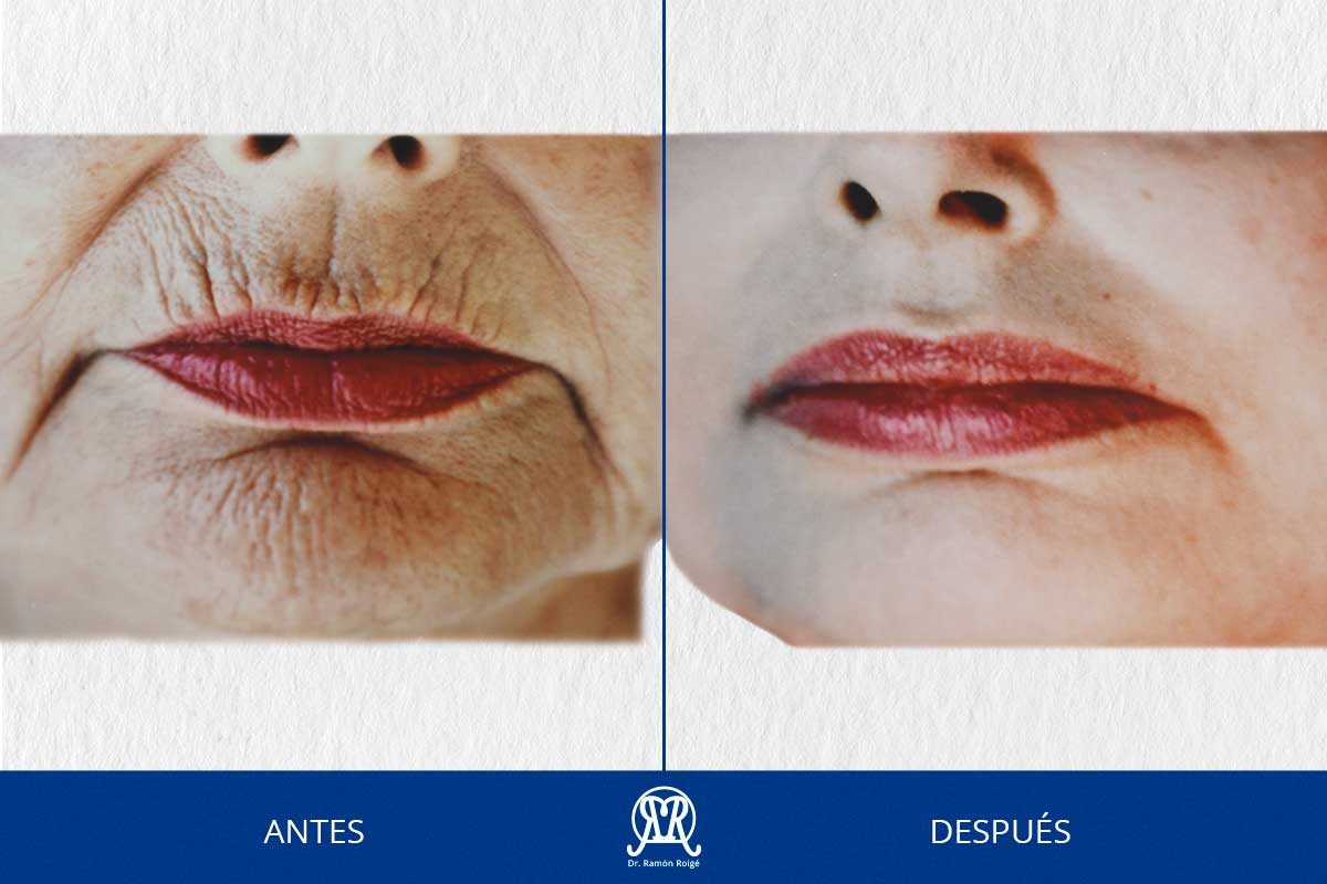 Caso 1: Molding Lip completo