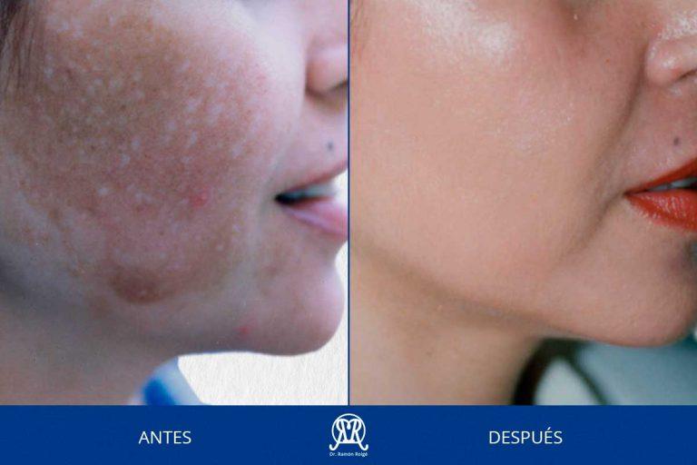 Caso 8: Melasma