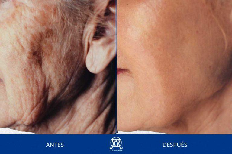 Molding-mask-melasma2-drramonroige