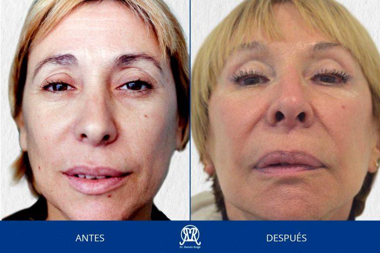 Molding-mask-principal--30anos-completo-drramonroige