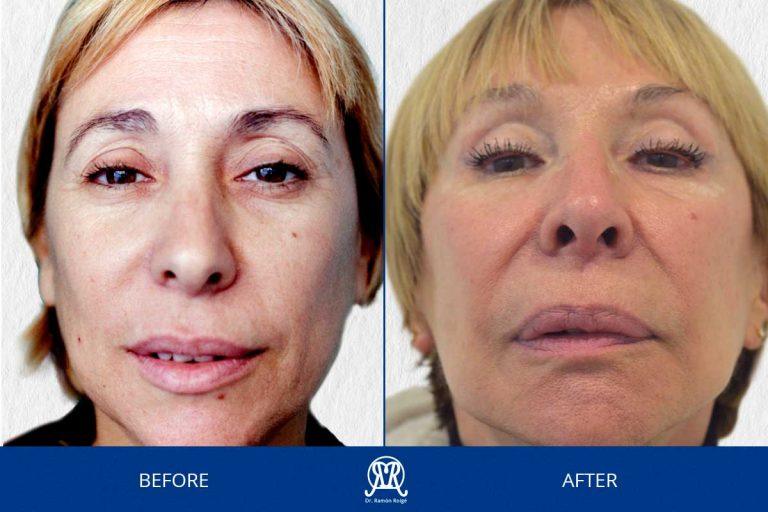 Molding-mask-principal--30years-completo-drramonroige