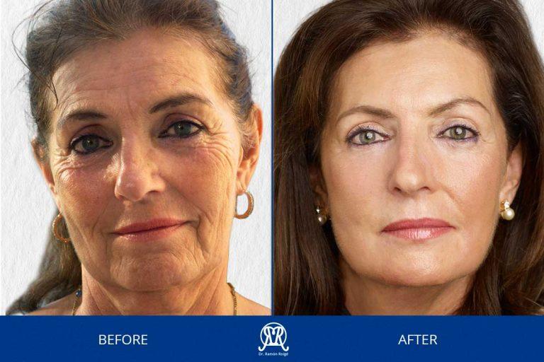 Case 1: Wrinkles