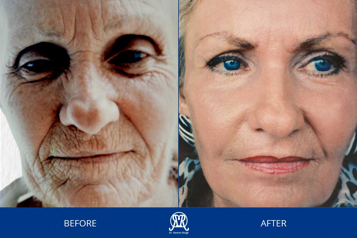 Case 2: Wrinkles