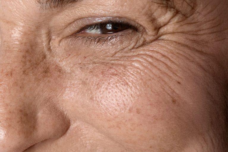 intrinsic and extrinsic skin aging-3