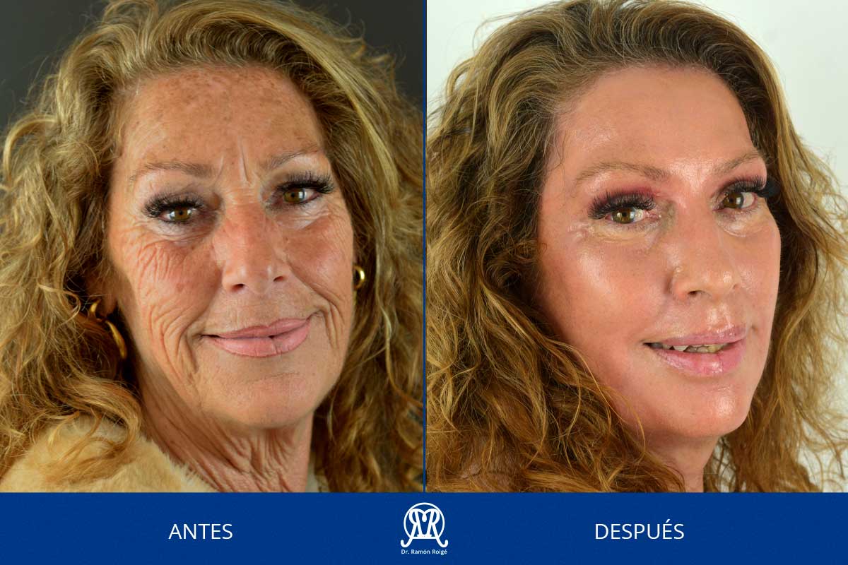 Medicina-estetica- facial-sin-cirugia-MoldingMask