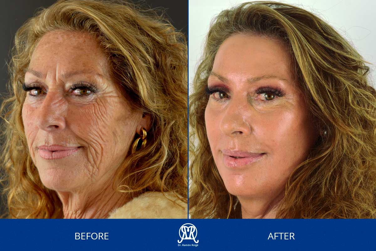 Facial-Aesthetic-Medicine-Without-Surgery