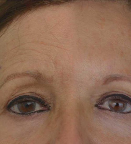 toxinabotulinica-inicio-drramonroige toxinabotulinica-inicio-drramonroige